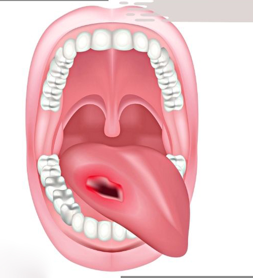 Tongue Cancer